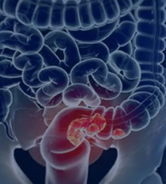 Estudo projeta aumento de 36% em mortes por câncer colorretal até 2040